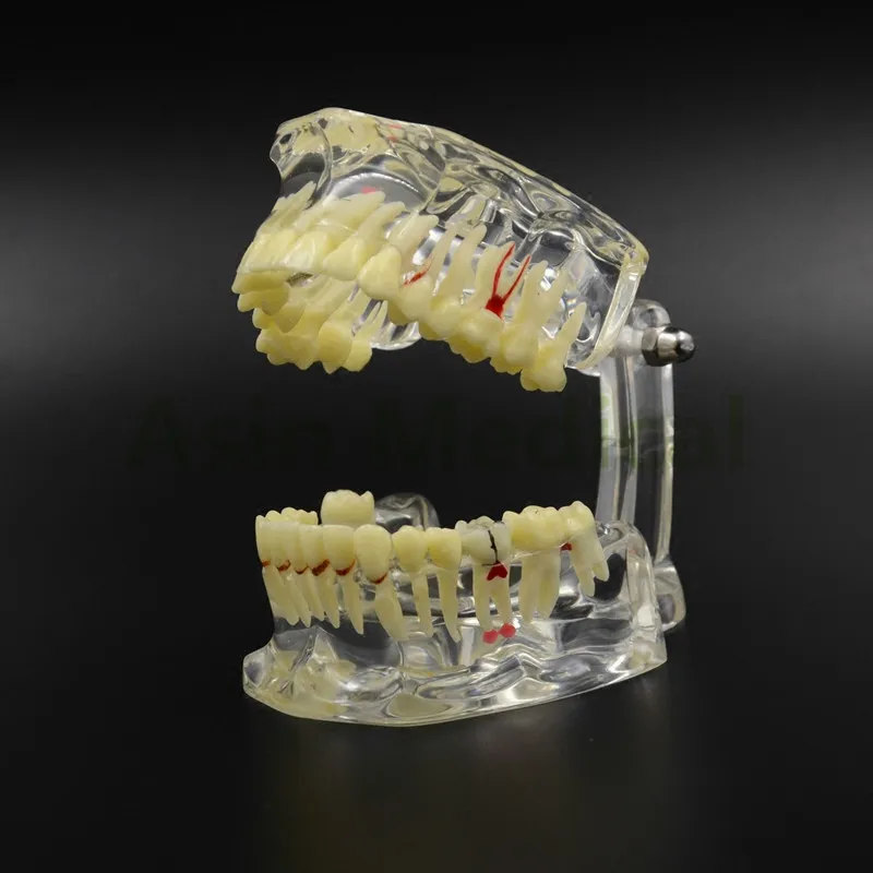 

Dental Implant Disease Tooth Pathological Extrusion Missing With impacted tooth dental pathological teeth implant