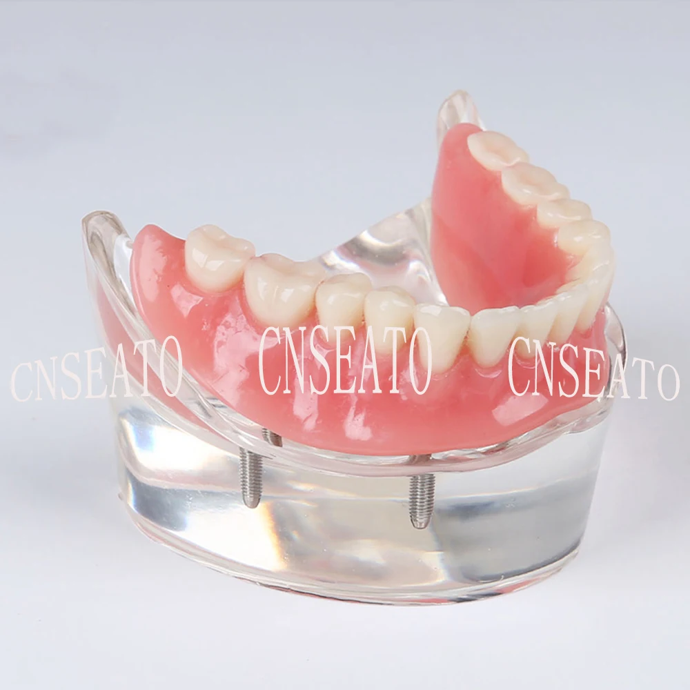 1 шт. стоматологический имплантат восстановление демонстрационная модель зубов M