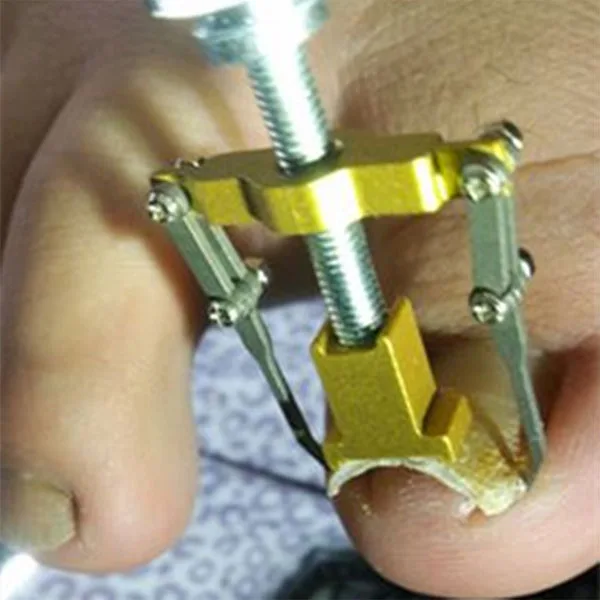 1 шт. инструмент для коррекции вросших ногтей | Красота и здоровье