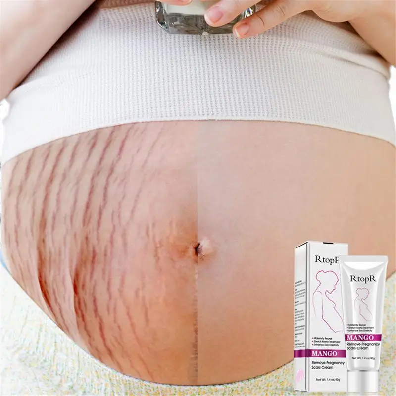 Mango Remove Pregnancy Scars Acne Cream Stretch Marks Treatment Maternity Repair Anti-Aging Winkles Firming Body | Красота и здоровье