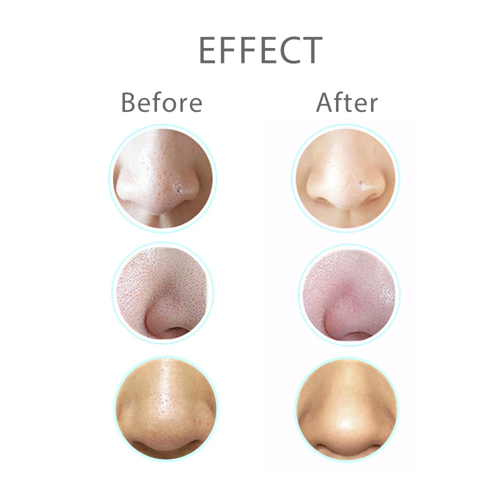 Электрический аппарат для удаления черных точек устройство на лице|Устройство