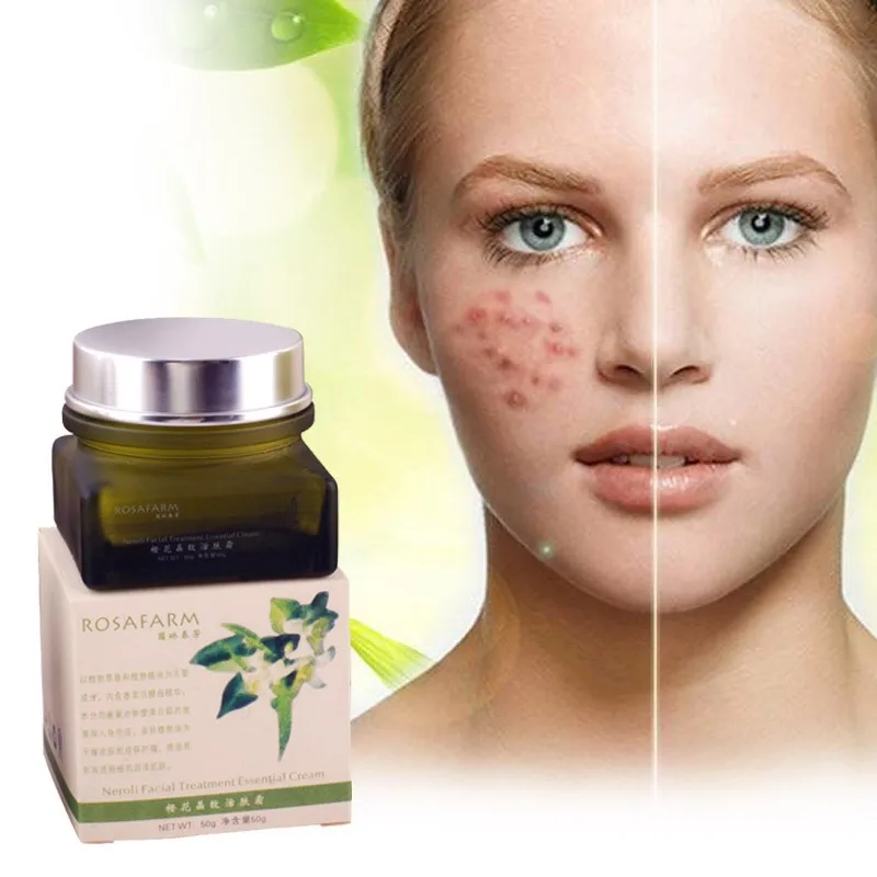 Крем для лица с экстрактом прыщей и черных точек 40 г|acne remover|acne facialacne control |