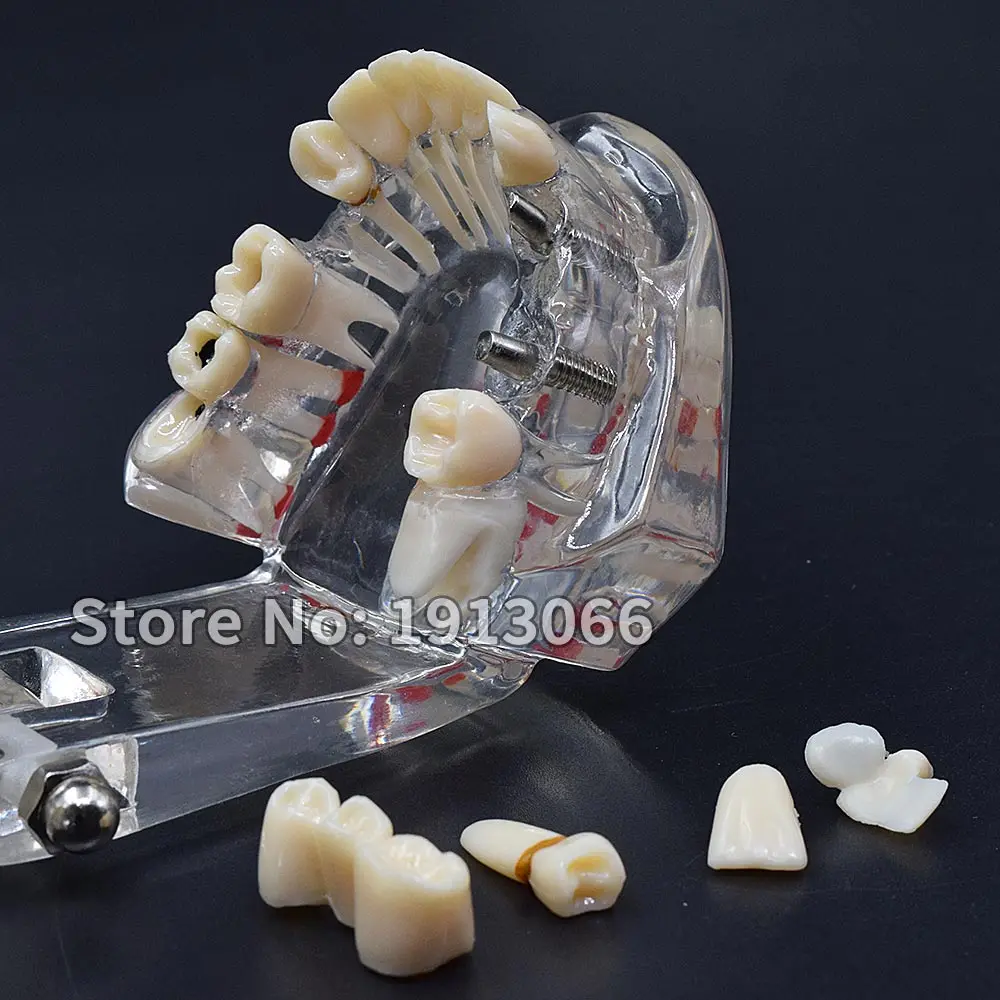 Модель зубного имплантата 1 шт. модель зубных протезов с реставрационным мостом