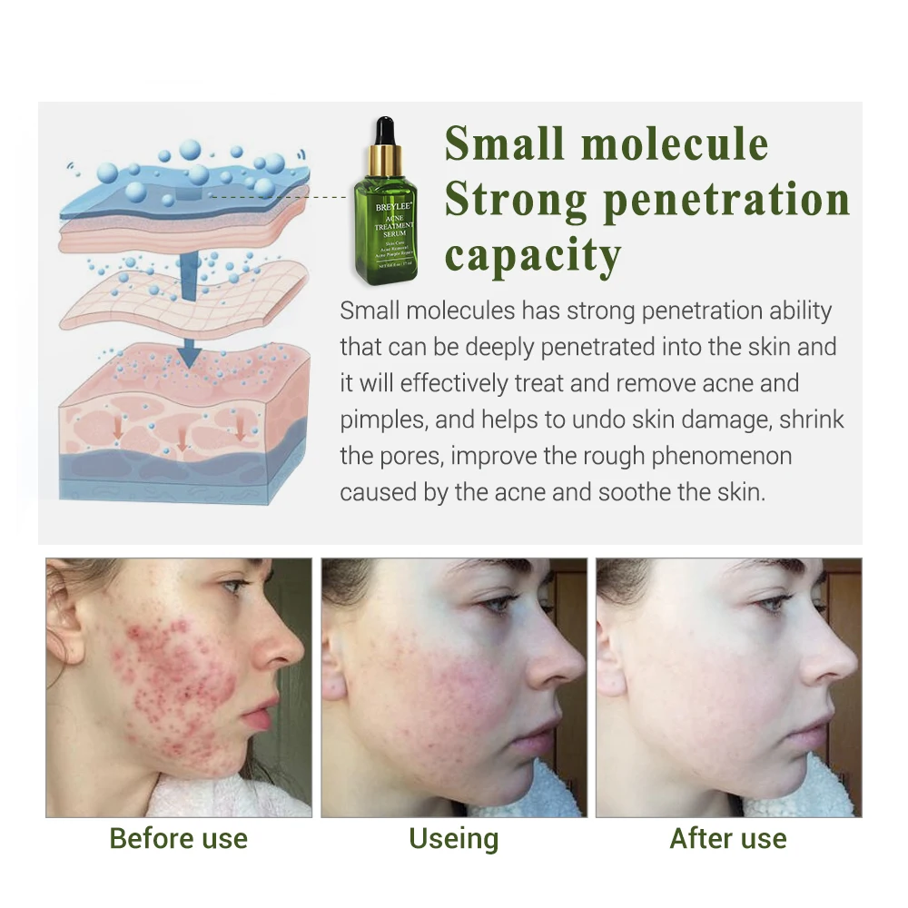 

BREYLEE Acne Treatment Serum Repair Pimple Removal Scar Facial Tea Tree Extract Whitening Pore Minimizer Skin Care 17ml