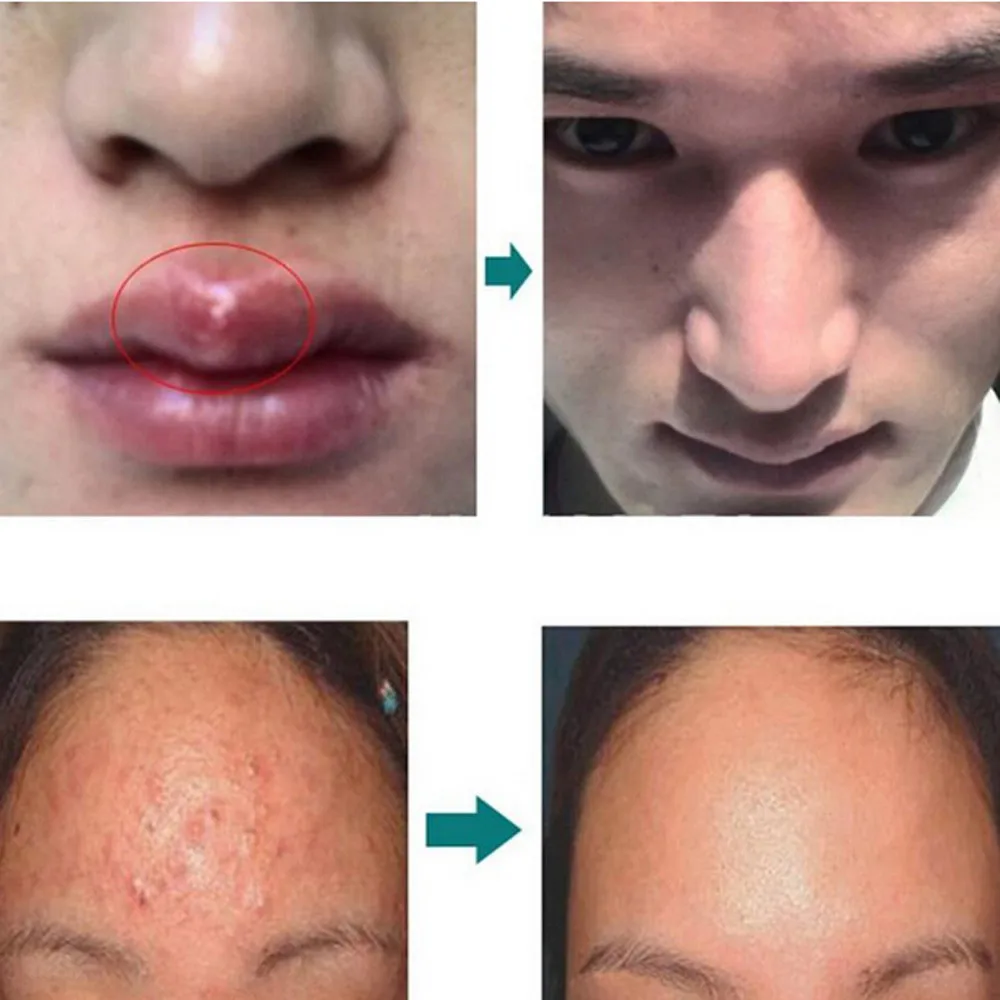 Новинка 2018 эффективный крем для ухода за кожей лица удаления акне пятна шрам