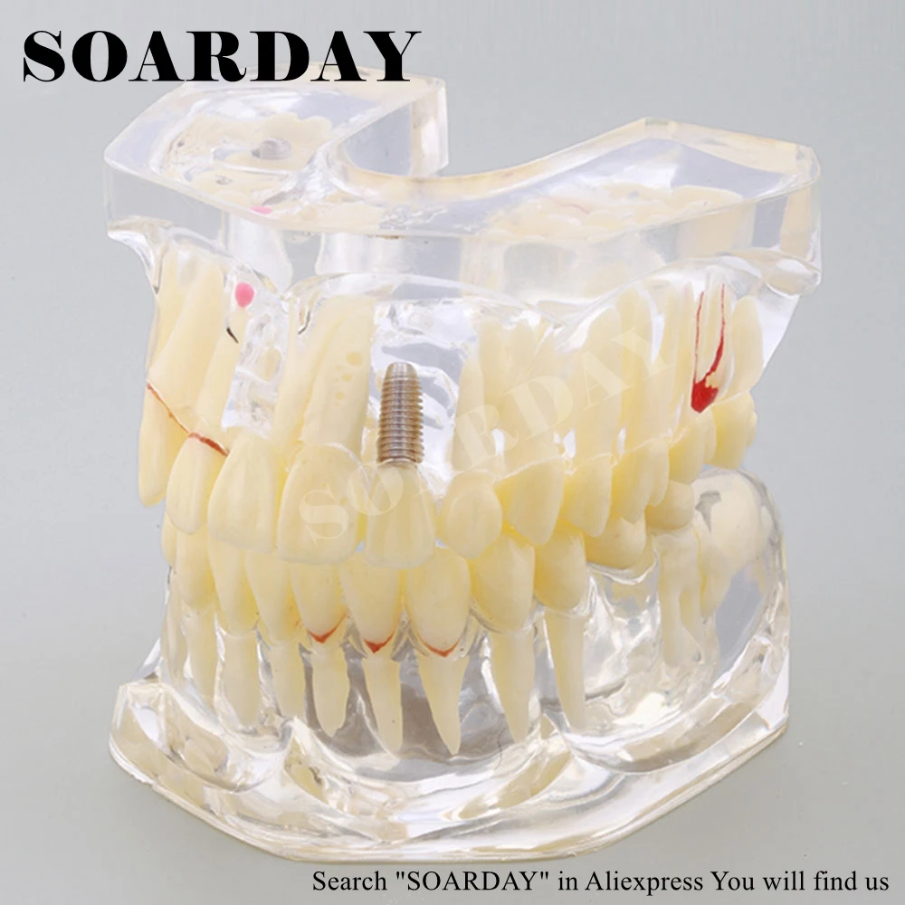 1 шт. стоматологическая патологическая модель импланта SOARDAY|bridge implant|implant modeldental