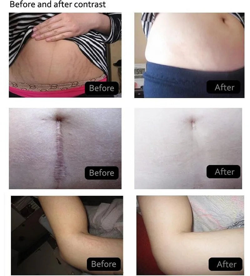 

2pc Pregnancy Stretch Mark Scar Serum Repair Essence Remover Oil Postpartum Care Maternity Body Smooth Skin Repair Cream