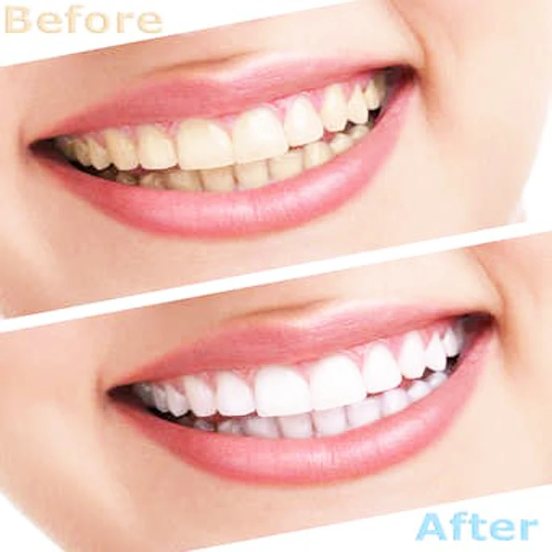 5pcs 5ML Teeth Whitening Peroxide Gel 10% 25% 35% Teeth Whitening Syringe hydrogen peroxide Gel images - 6