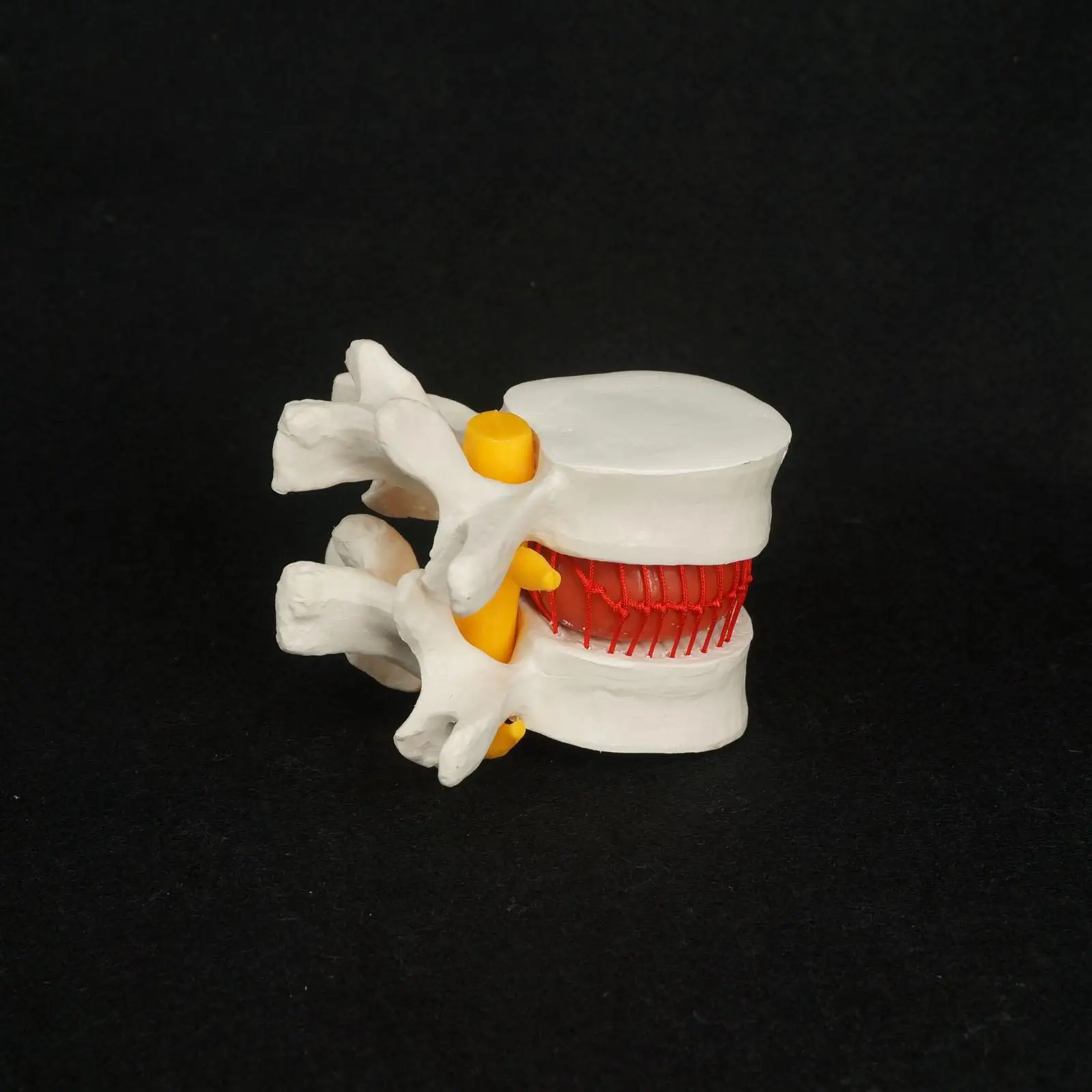 Анатомическая грыжа поясничных позвонков диск пролапс модель человека