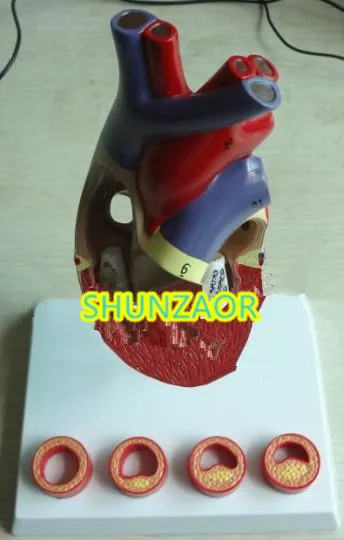 Атеросклерозный пластик модель сердца человека медицинское учение| |