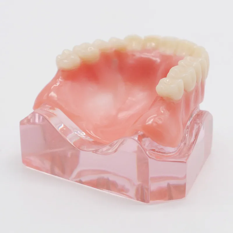 Dentist Overdenture Upper Anterior Maxillary 4 Implants Restoration Teeth Model For Dentistry Lab | Красота и здоровье