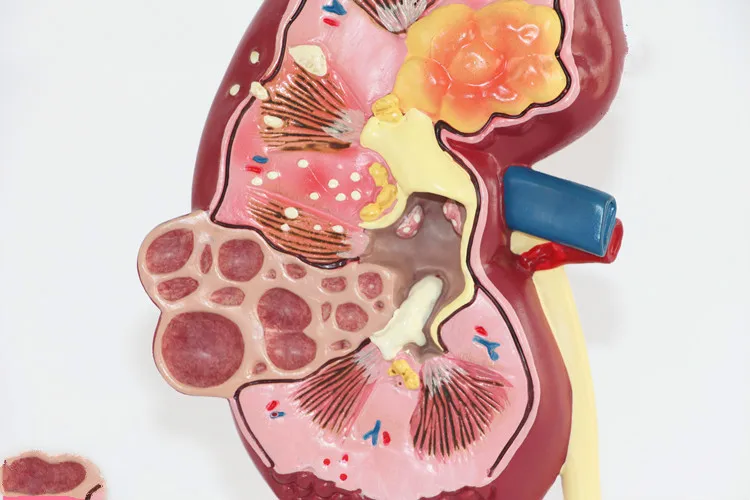 Модель анатомических заболеваний почек для человека LifeSize урология нефрон модель