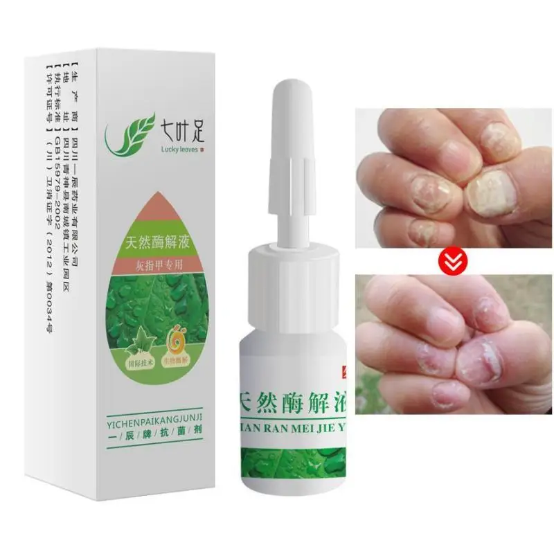 4ml Bacteria Fungus chinese medicine Onychomycosis Paronychia Anti Fungal Nail Infection L3 | Красота и здоровье