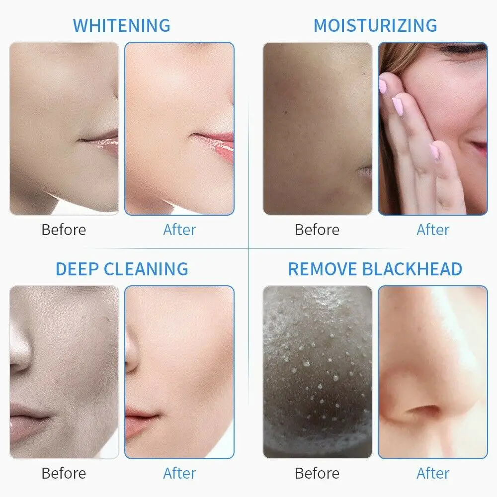 

6 In 1 Facial Water Peeling Microdermabrasion Hydro Dermabrasion Beauty Machine