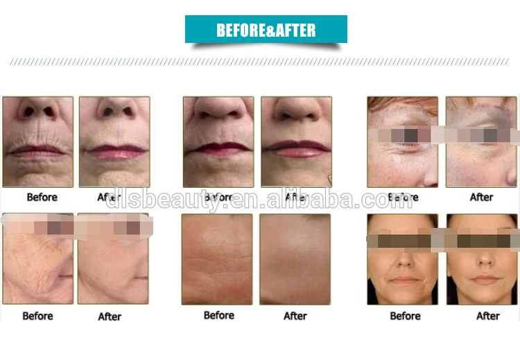 Máquina портативный de la belleza дель equipo médico antiarrugas de elevación лица основные de Hifu del nuevo cartucho