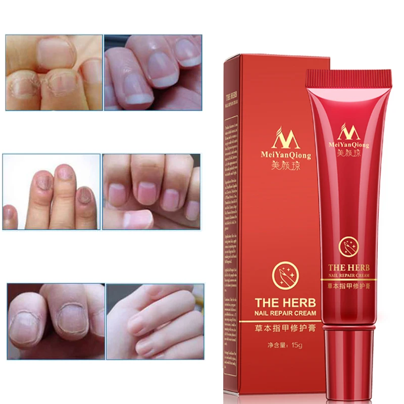 

Fungal Nail Feet Care Essence Nail Foot Whitening Toe Nail Fungus Removal Gel Anti Infection Paronychia Onychomycosis Plaster