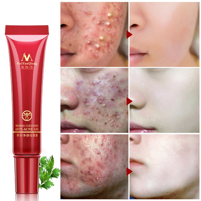 

Meiyanqiong face Acne Cleaning Cream 15g quickly repaire face acne remove Comedone Pimple skin care whitening cream MY005