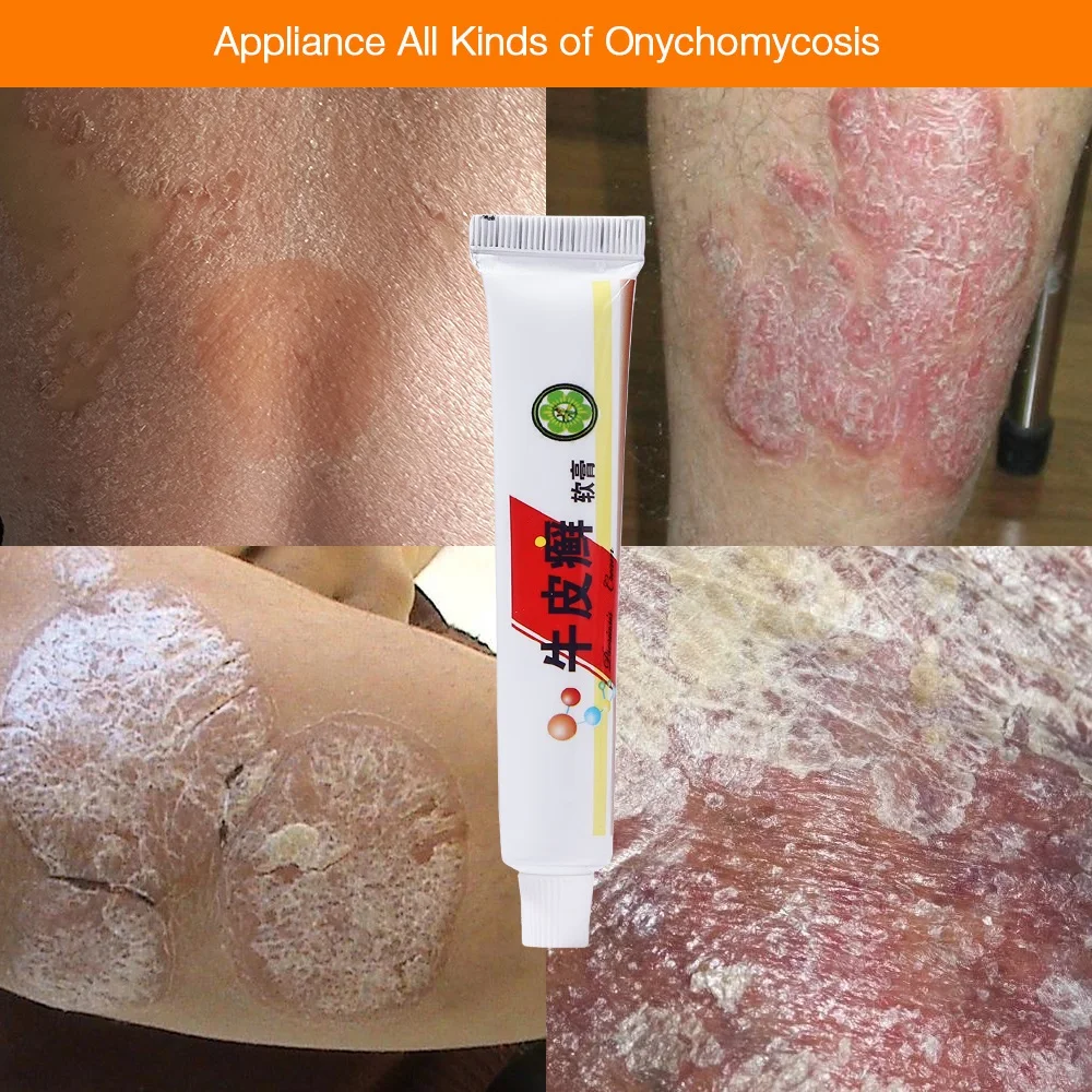 Psoriasi крем от экземы работает идеально подходит для все виды кожи проблемы патч