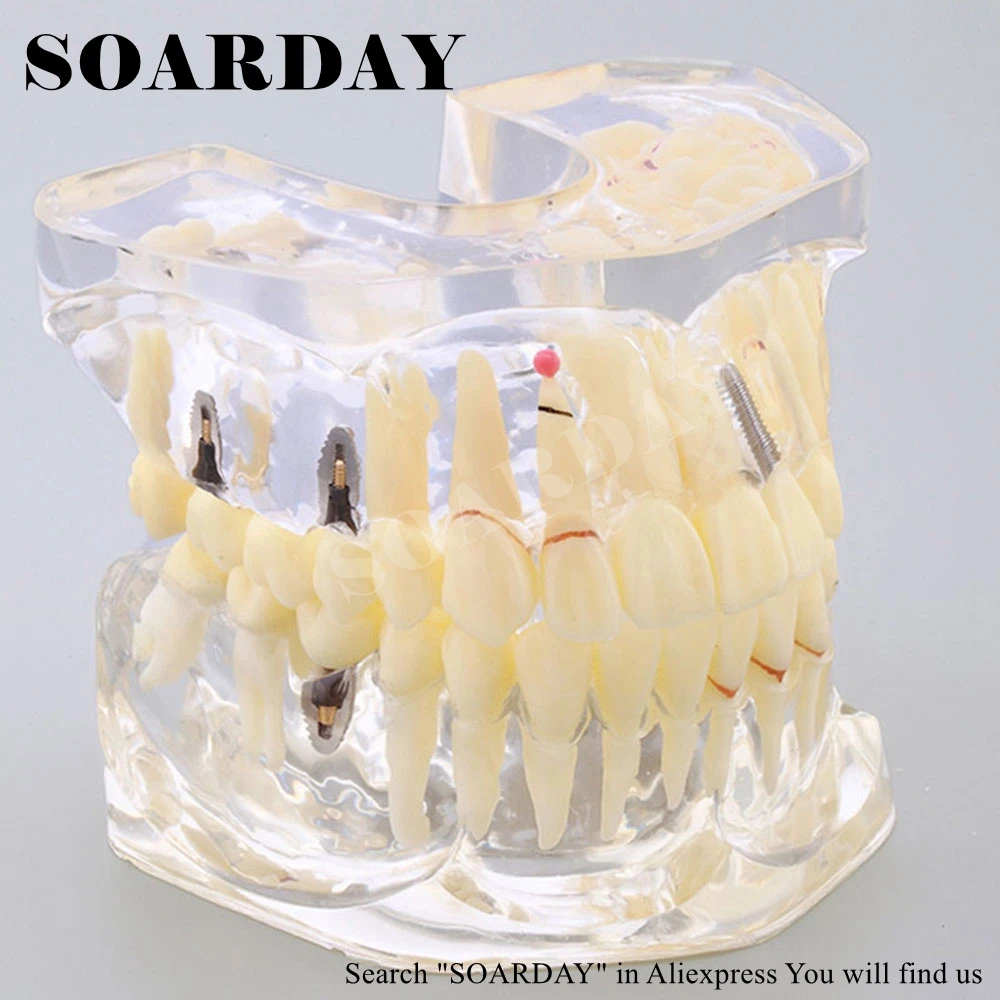 1 шт. стоматологическая патологическая модель импланта SOARDAY|bridge implant|implant modeldental