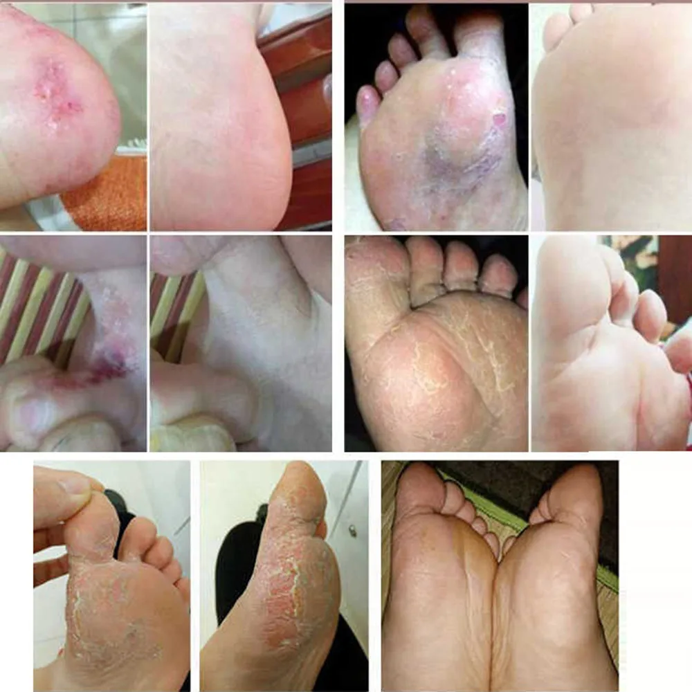 

Cracked Heel Balm Cream For Foot Mask Feet Cream Dead Skin Removal Foot Care Rough Tool Removing Cracked Chapped Feet Heel Skin