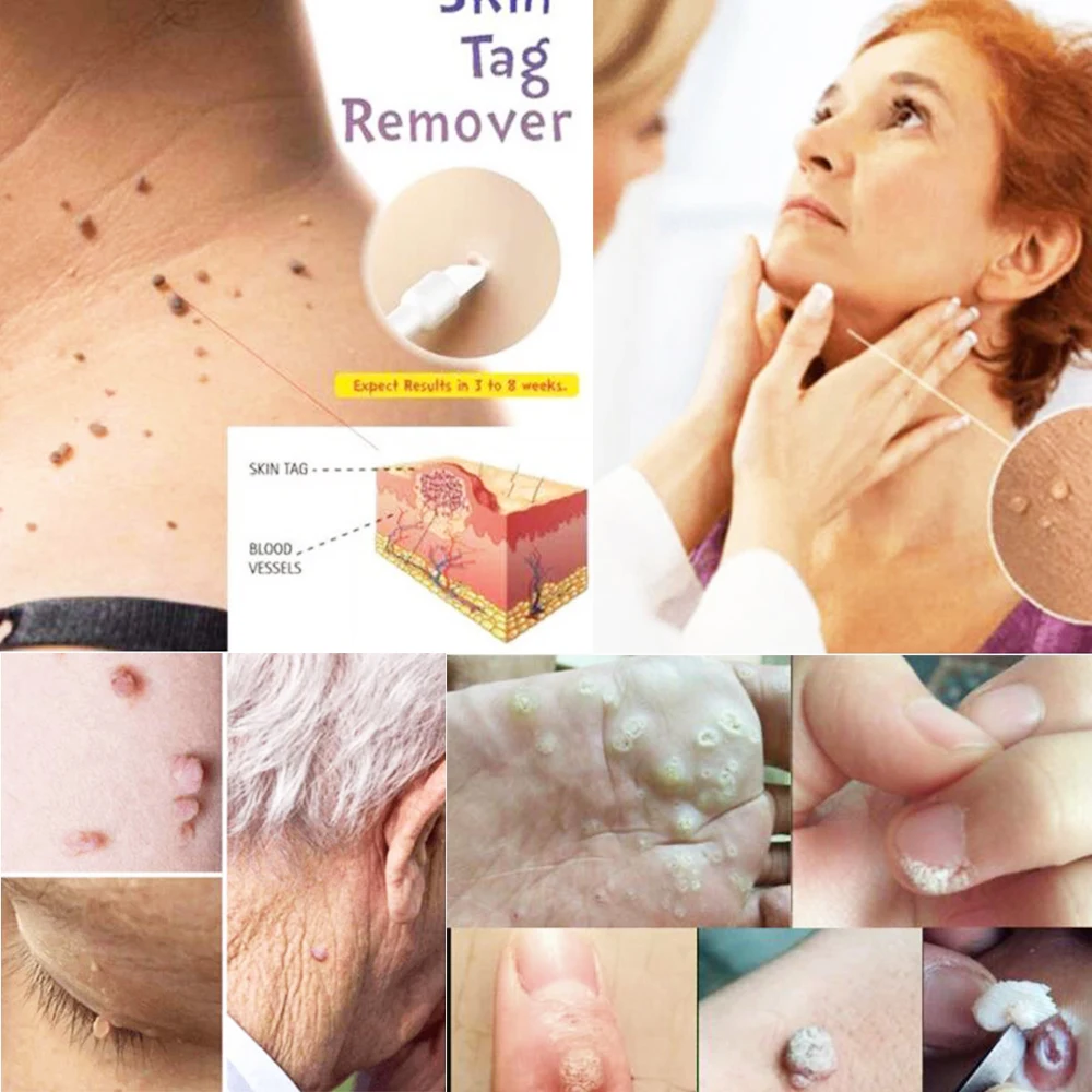 100% профессиональное средство для удаления следов кожи натуральный здоровье моль