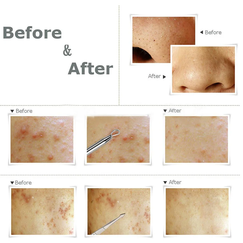 9 шт. чистка лица нержавеющей очиститель пор игольчатый Пинцет для прыщей