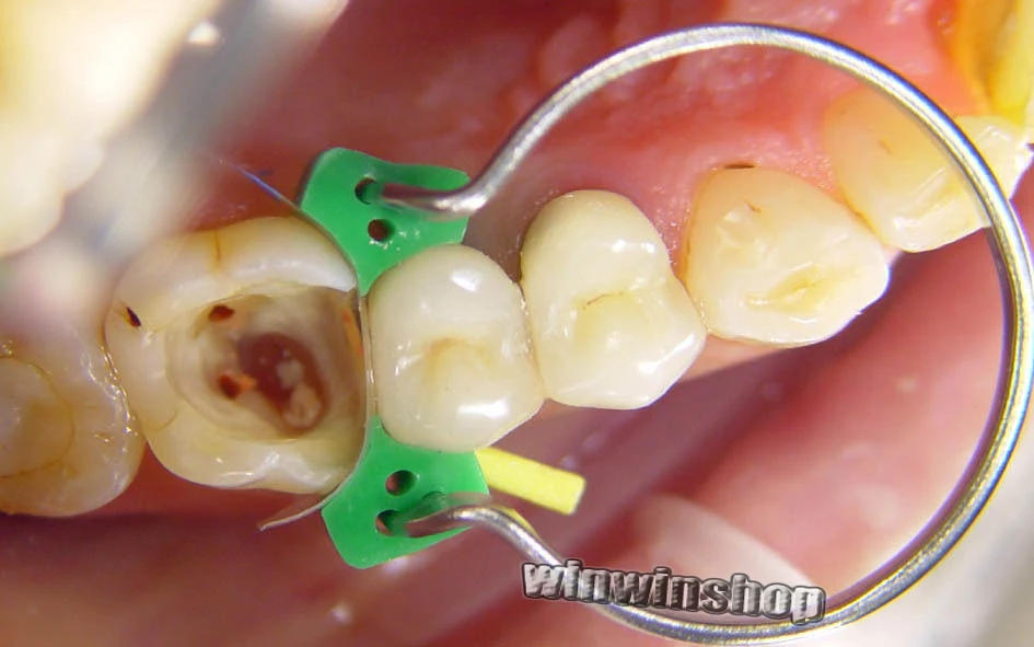 100 шт. стоматологические Контурные матрицы Φ Delta + 40 дополнительных клинов |