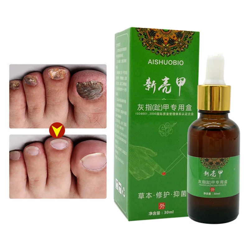 30 мл онихомикоза специальная жидкость для ремонта ногтей стерилизация