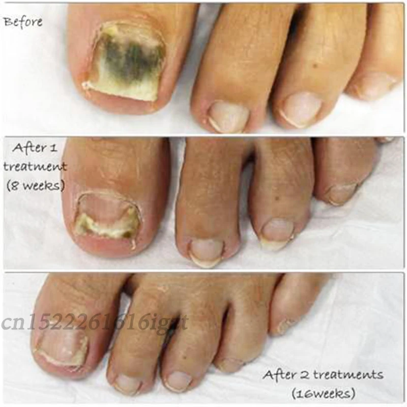 Лечение ногтей от грибка детоксикация ног |