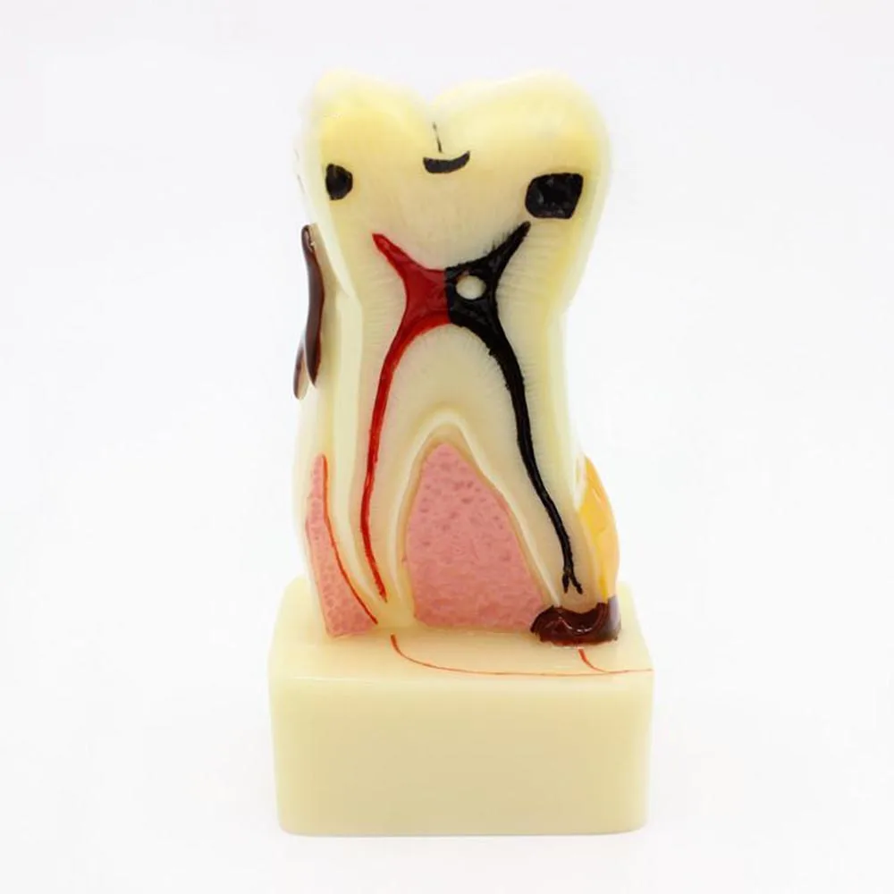 Модель анатомии для выполнения обычных патологий зубов модель кариес