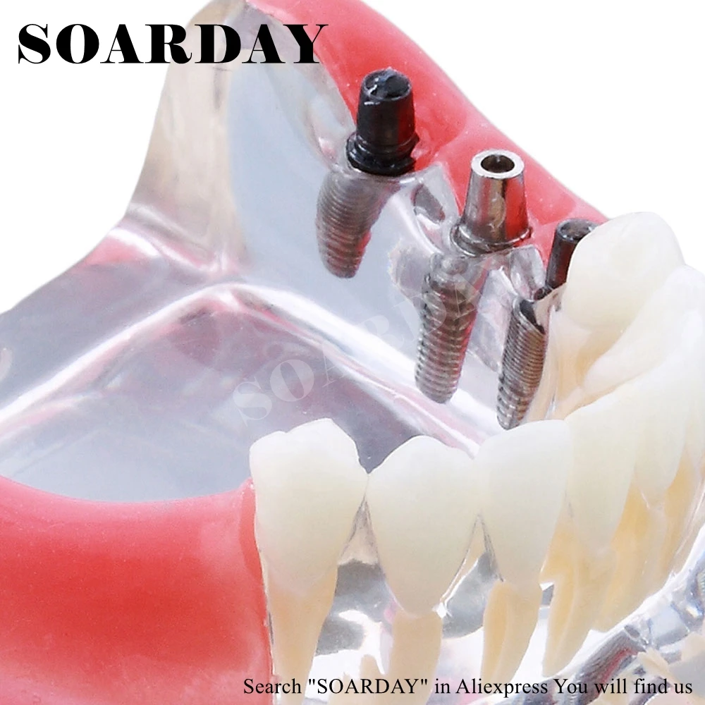 Модель имплантации и коррекции зубов SOARDAY модель анатомической анатомии