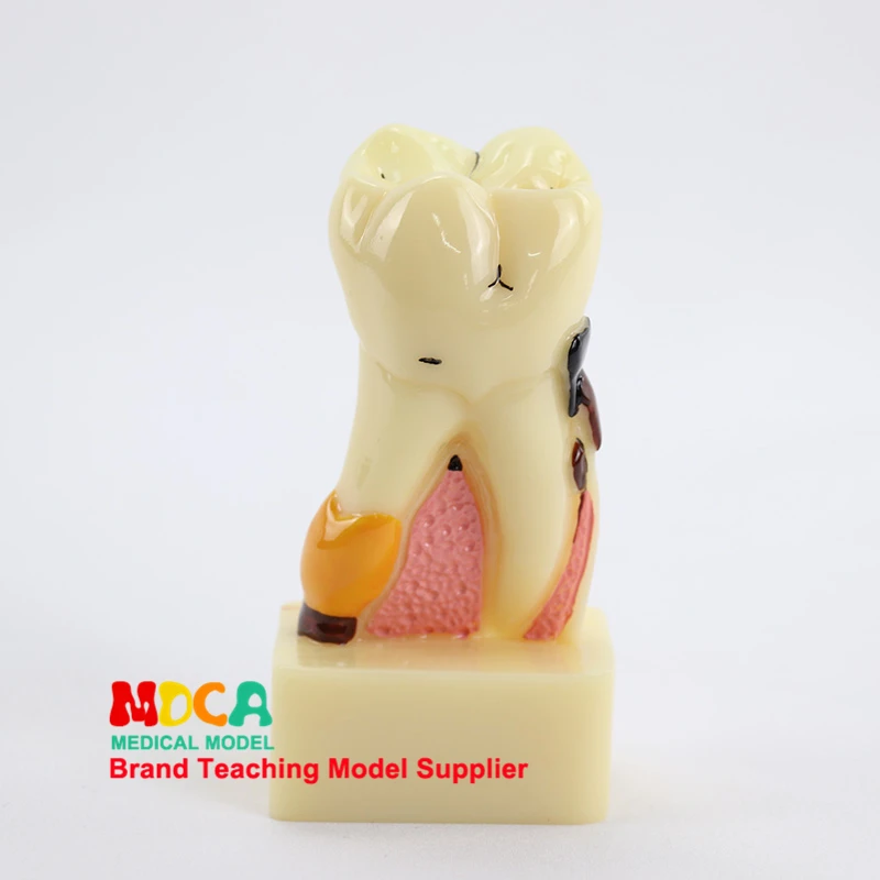 

Dental pathological anatomy model dental caries gingival display medical teaching model MYC009