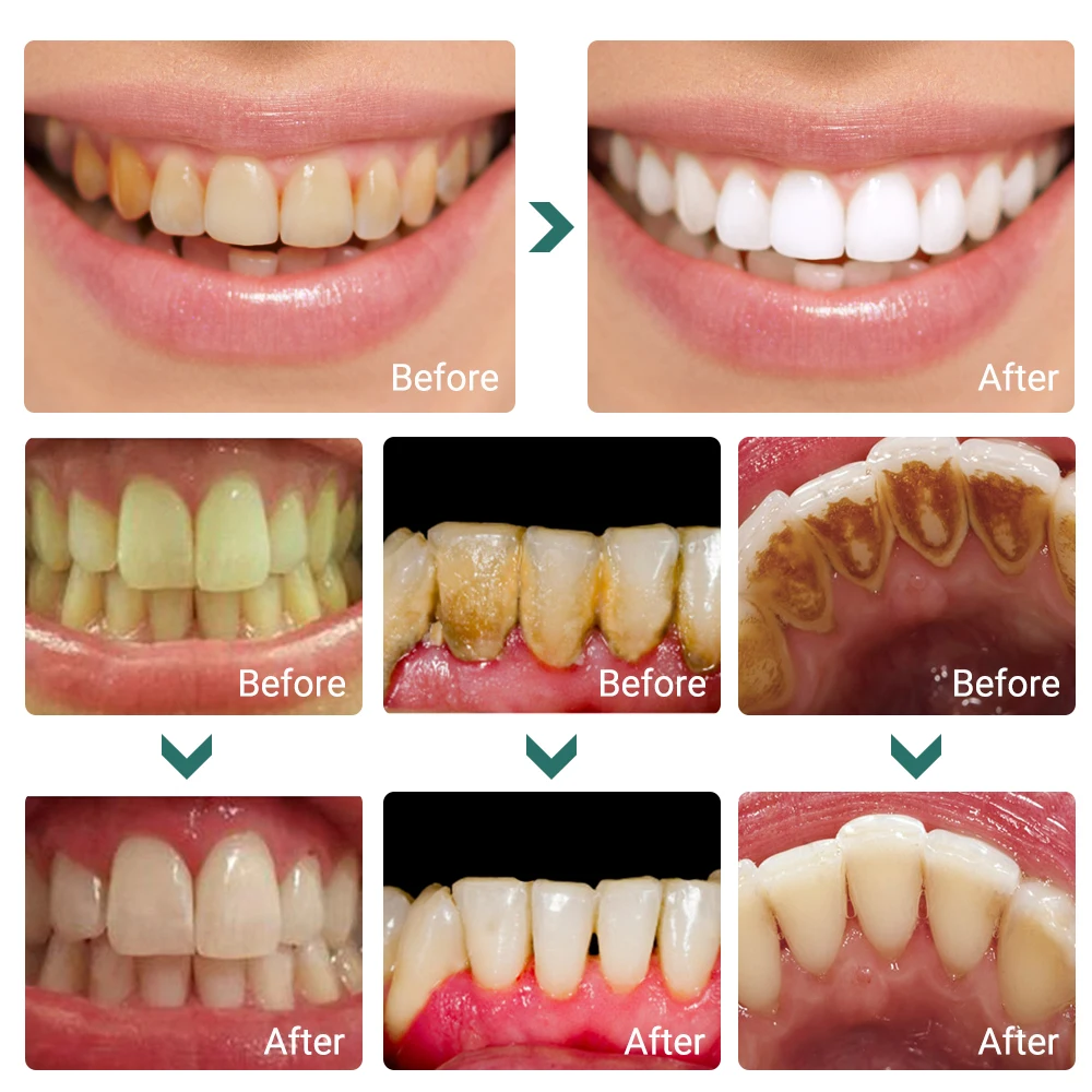 Soonpure Teeth Whitening Powder Dental Tools Snap On Smile Oral Hygiene Cleaning Tooth Cleaning Essence Teeth Care Toothpaste