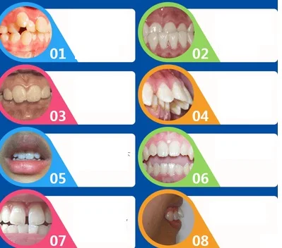 Детские Ортодонтические корректоры для выравнивания зубов T4K | Красота и