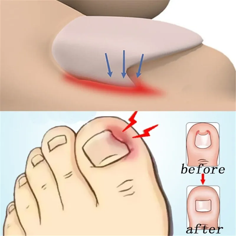 2 шт./компл. средство для удаления грязи из омертвевшей кожи педикюр уход за