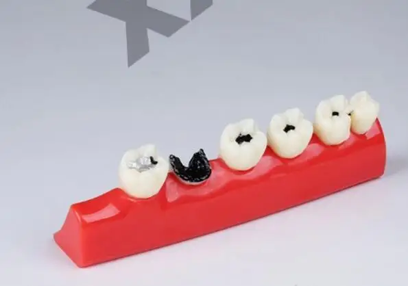 tooth nerve Dental Materials Caries Show model pathology teaching model free shipping