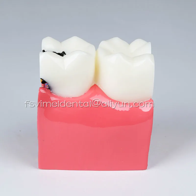 

High Quality 2016 NEW Denture Teeth model 6X, caries comparison model, tooth decay model,Dentist for Medical Science Teaching