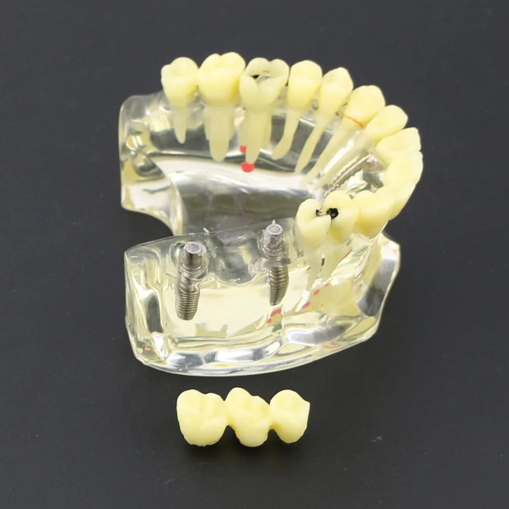 Зубные Исследование Научите Зубы Модель Dental Implant верхней челюсти модель с моста и кариеса