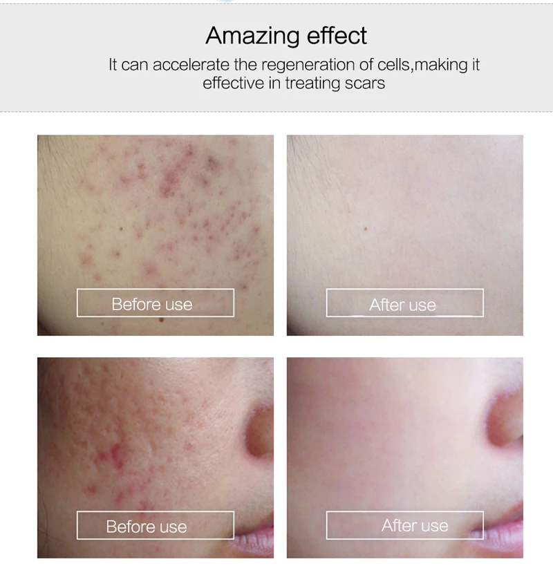 

EFERO Acne Face Serum Hyaluronic Acid Essence Face Care Shrink Pores Anti Acne Removal for Acne Treatment Face Cream Whitening