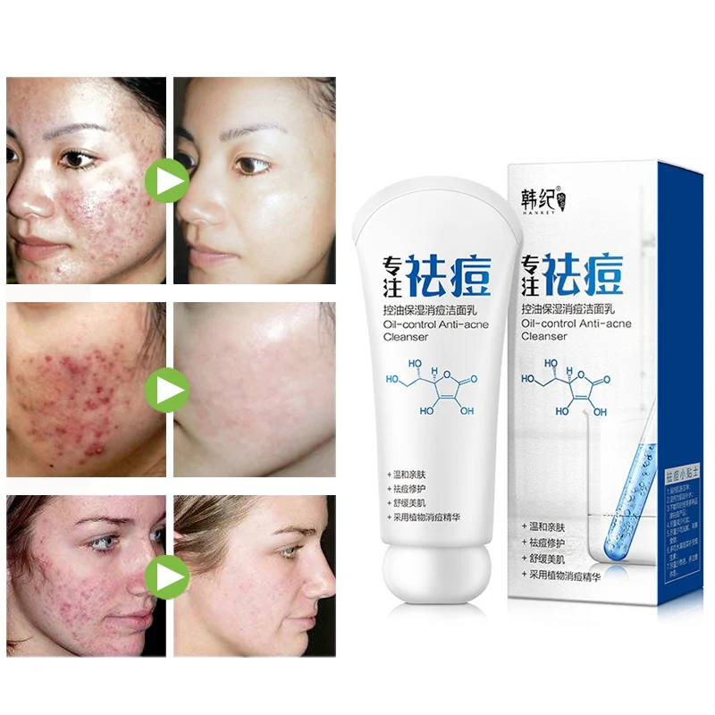 Новое очищающее средство для лица 80 г лечения акне удаления черных точек с