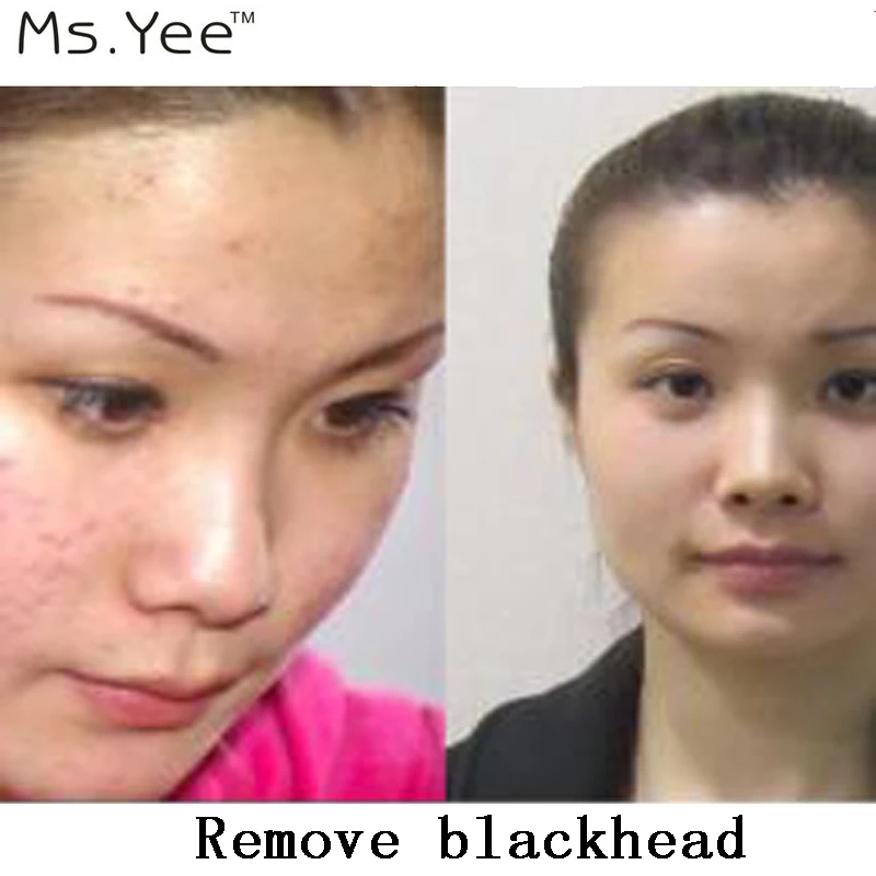 Очищает поры и очищает кожу Ms. Yee 100% чистое составное эфирное масло удаляет