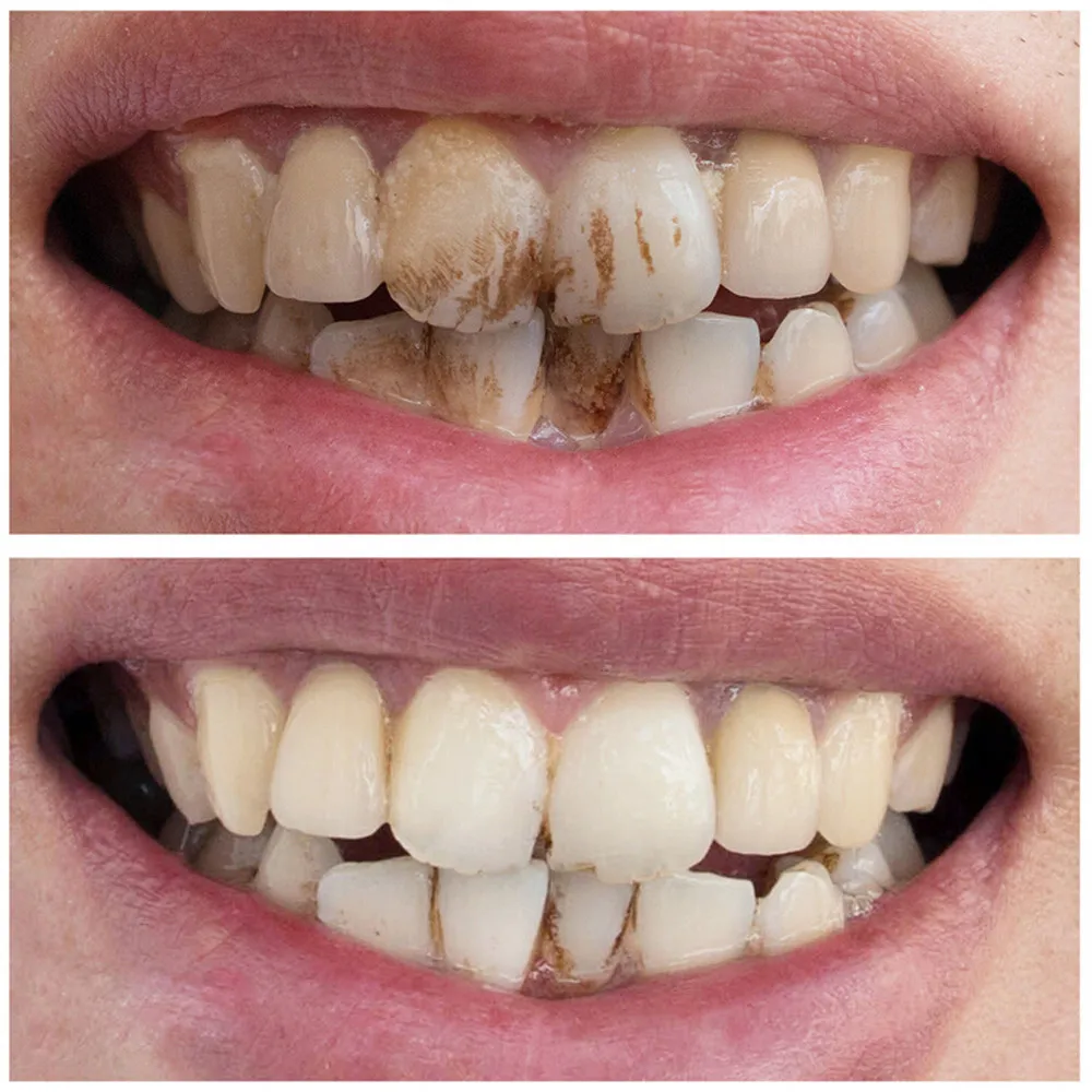 10 мл отбеливающая вода для гигиены полости рта уход за зубами T ooth Чистка