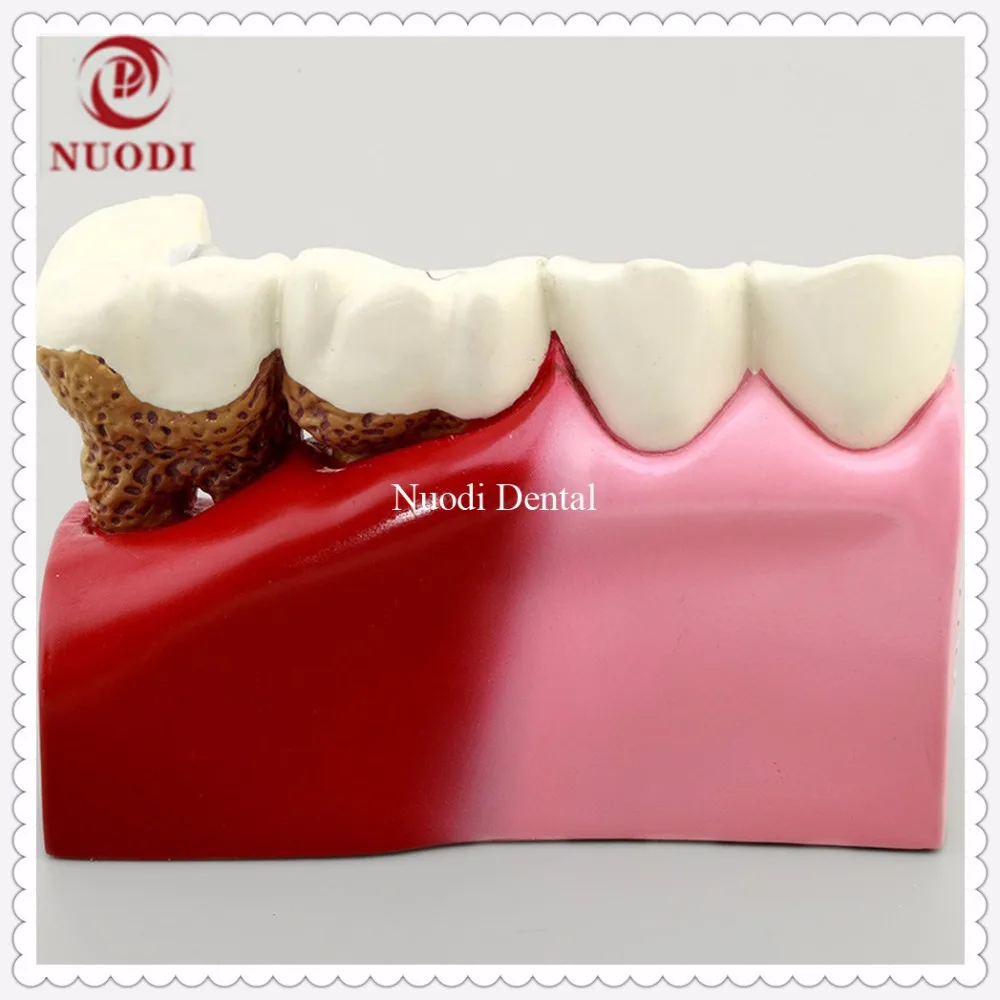 Dental Implant Teeth Model/Dentistry Disassembling Caries dental tooth Model/4times teeth model |