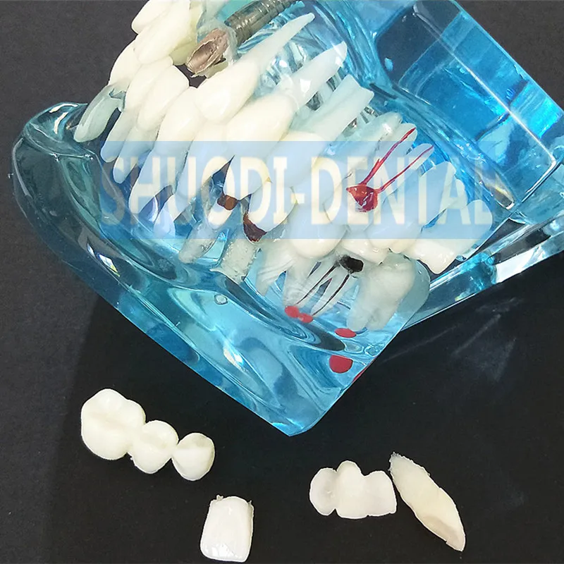 Хит продаж модель зубного импланта с реставрационным мостом зубной протез для