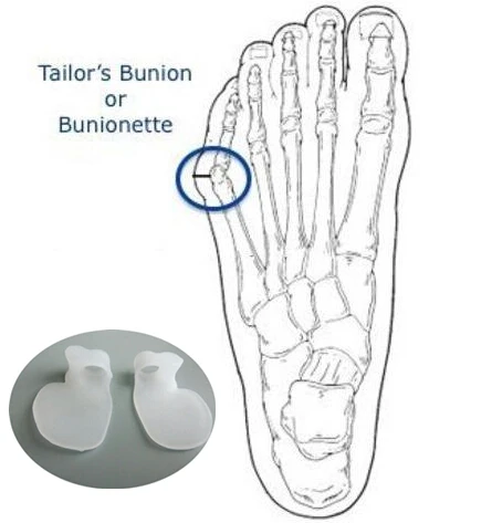 2 шт./лот силиконовый разделитель для снятия боли с маленького пальца вальгусная