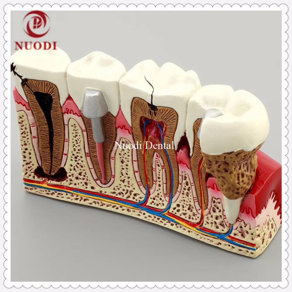 Dental Implant Teeth Model/Dentistry Disassembling Caries dental tooth Model/4times teeth model |