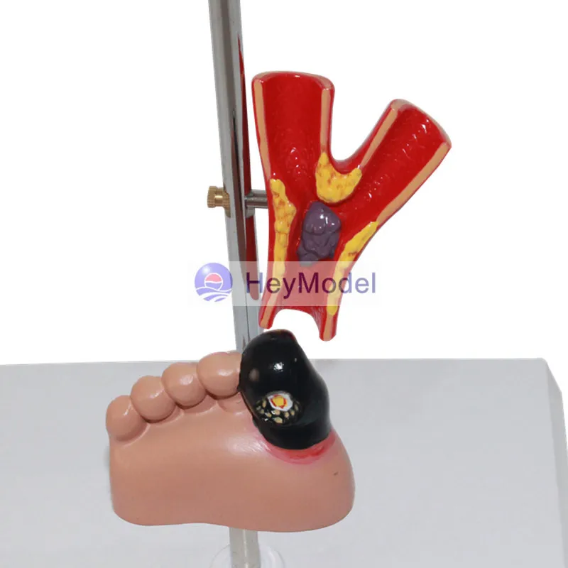 HeyModel человеческий диабет модель очага повреждений|Образовательное