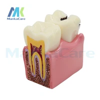 1pcs 6x denture teeth model caries comparison model tooth decay model dentist pathologies for medical science teaching