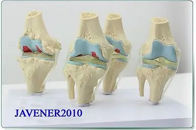 4-Part Human Anatomical Knee-Joint Diseased Contrast Medical Model