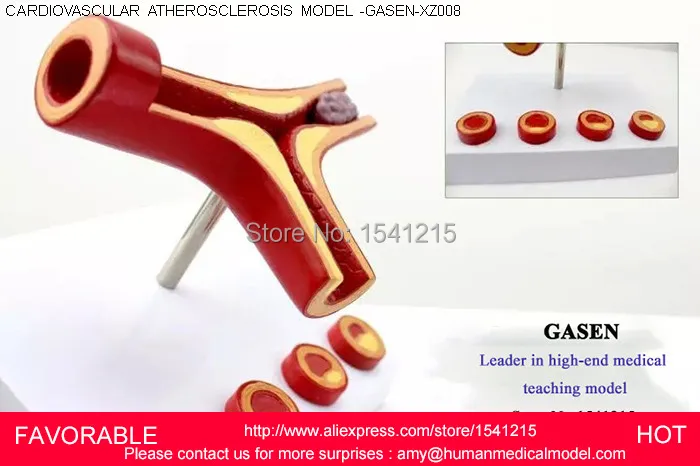 Анатомическая сосудистая атеросклерозная патология человека медицинский орган